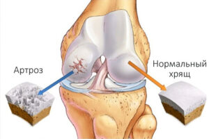 Лечение артроза в Израиле