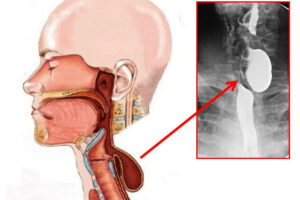 Дивертикул пищевода