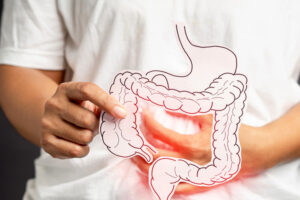 Лечение язвенного колита в Израиле