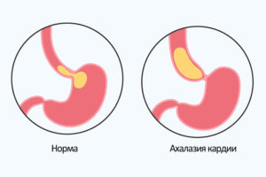 Ахалазия кардии