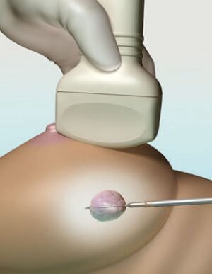 Биопсия молочной железы