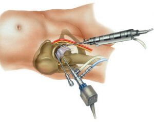 Артроскопия тазобедренного сустава