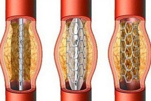 Коронарная ангиопластика, стентирование