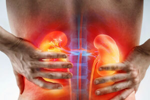 Лечение рака почки в Израиле