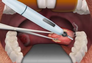 Удаление миндалин лазером