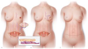 DIEP-лоскут — пластика груди