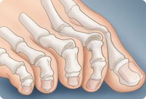 Деформация пальцев стопы