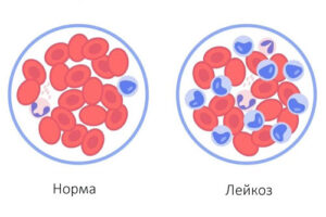 Лечение острого лимфобластного лейкоза в Израиле