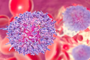 Лечение миелоидного лейкоза в Израиле