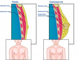 Гинекомастия 