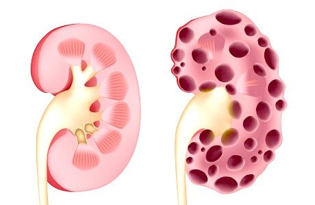 Поликистоз почек презентация