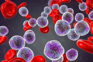 Лечение лейкемии в Израиле