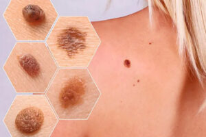 Лечение рака кожи в Израиле