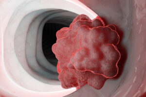 Лечение рака двенадцатиперстной кишки в Израиле