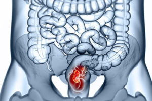 рак прямой кишки