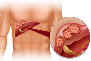 Лечение рака печени в Израиле