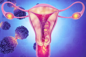 Лечение рака матки в Израиле