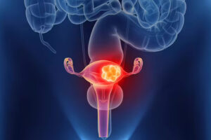 Лечение рака мочевого пузыря в Израиле