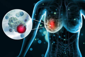 Лечение рака Педжета