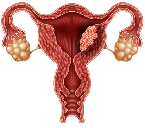 Лечение пузырного заноса в Израиле | клиника Assuta Complex