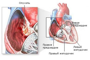 фиброма сердца
