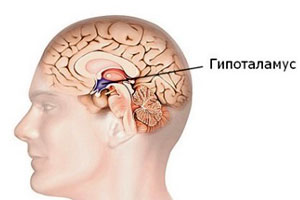 гамартома гипоталамуса
