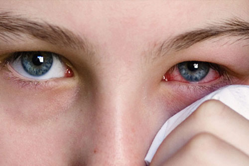 Лечение склерита в Израиле - стоимость лечения, отзывы | Ассута