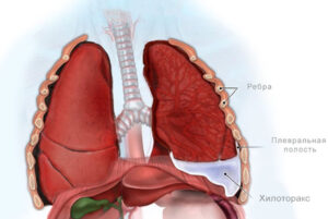  хилоторакс