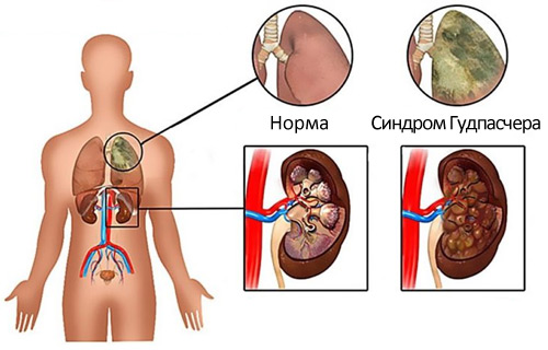 Сердечно-сосудистые заболевания | Клиника EuReCa (Эврика) - Киев