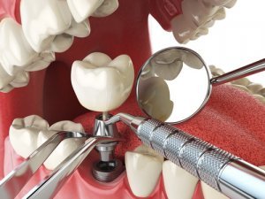 Виды имплантирования зубов