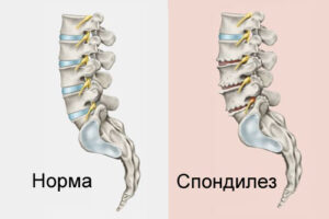Лечение спондилеза в Израиле